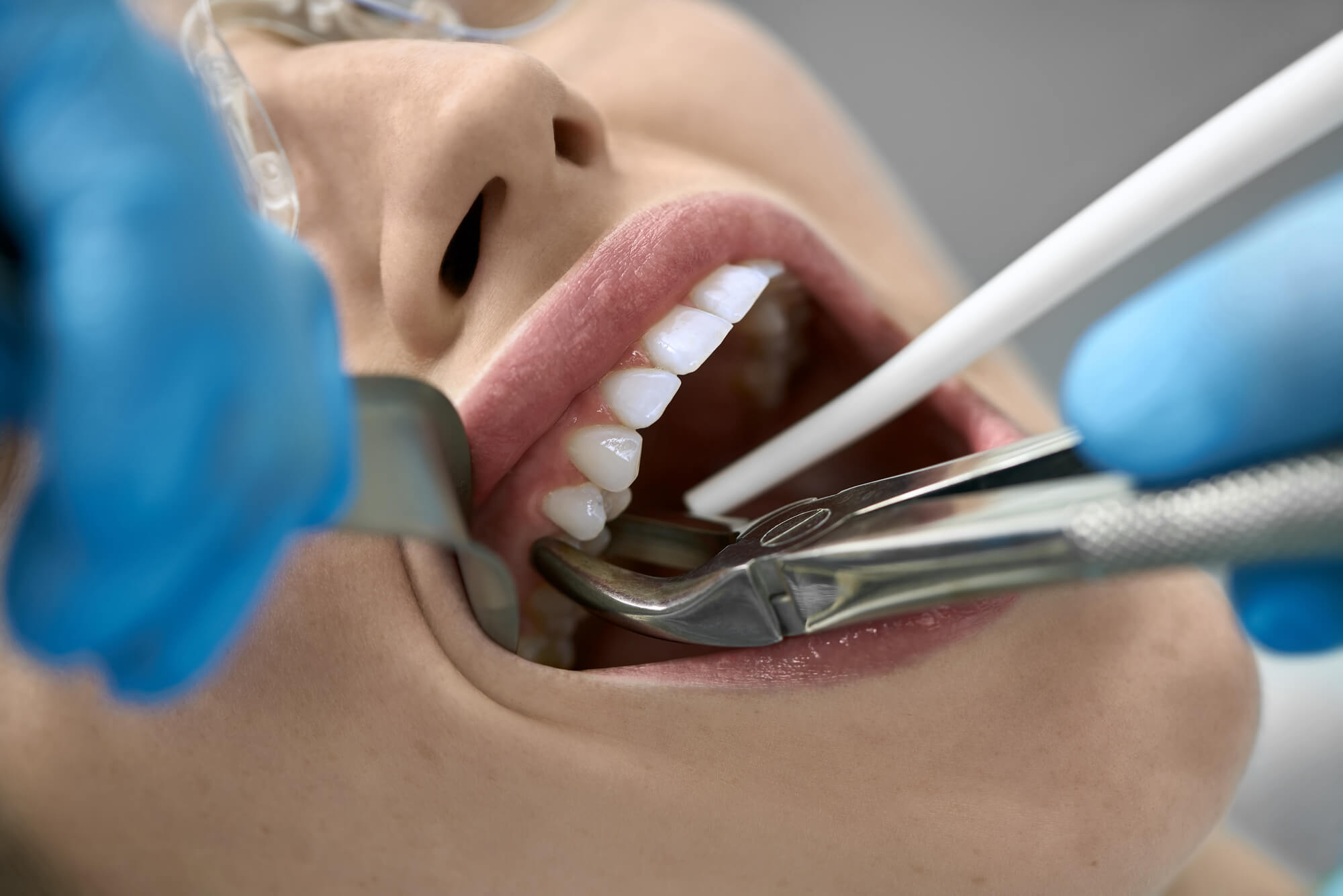 Teeth Removal And Surgery